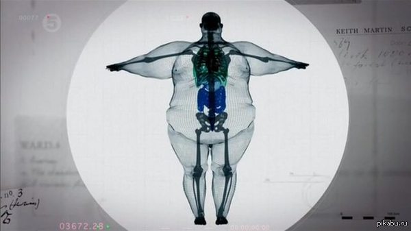 Рентген человека с широкой костью