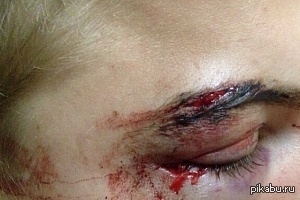 Укрофашисты избили брата за русский язык, надо отвезти в больницу, сама я не могу, нахожусь в г. Грозном