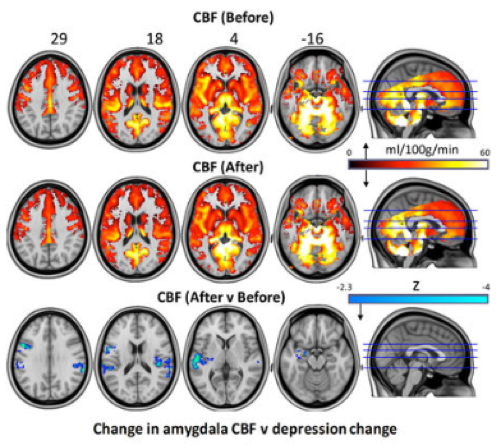 Hallucinogenic mushrooms have been shown to be effective in persistent depression - Research, Depression, Clinical trials, The medicine, Psilocybin, Miracle Mushrooms, Health, Benefit, Longpost