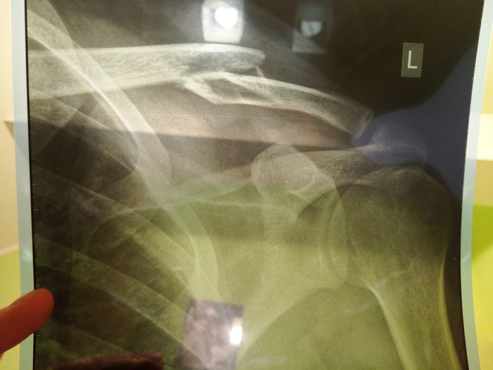 About Russian medicine or how I broke my collarbone. - My, Fracture, The medicine, Titanium plate, Surgeon, BSMP, Kaliningrad region, Longpost