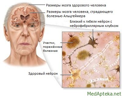 How diabetes affects Alzheimer's - My, The science, Interesting, Informative, Diabetes, Glucose, Alzheimer's disease, Research, The medicine