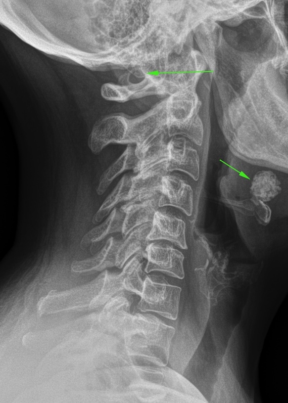 Снимок шеи. Аномалия Киммерли рентген. Аномалия Киммерли в шейном рентген.