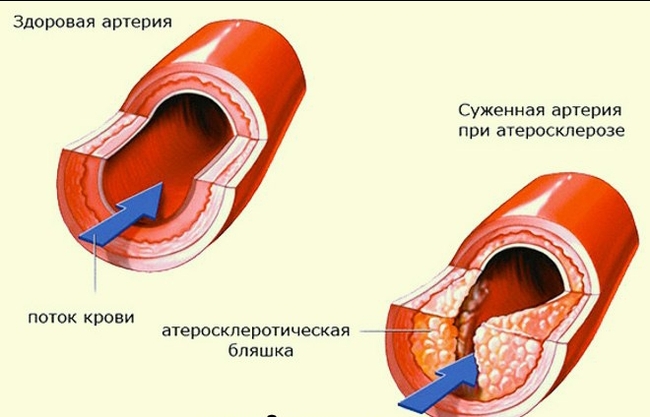 Cardiovascular system, atherosclerosis, or how to live to a hundred years - My, Sport, The medicine, Heart, Vessels, Health, Sports Tips, Тренер, Training program, Longpost