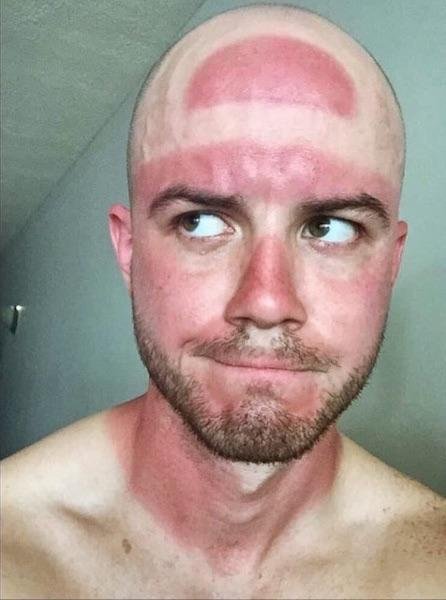 Another global question. - My, Bald, Tan, Protractor, Cap, Question, , , Tag, Sunscreen