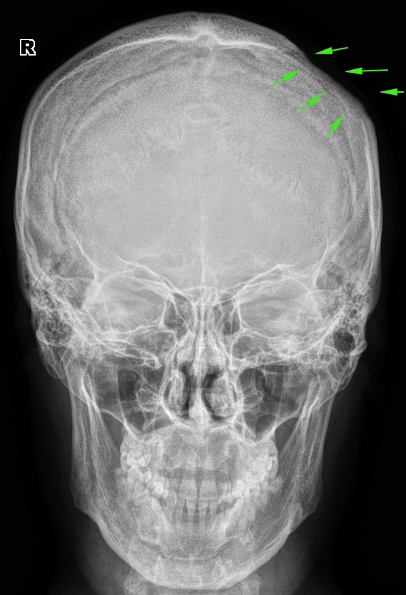 Сотрясение кости. Перелом лобной кости рентген. Перелом костей черепа рентген. Перелом затылочной кости рентген. Перелом черепа на рентгене лобной кости.