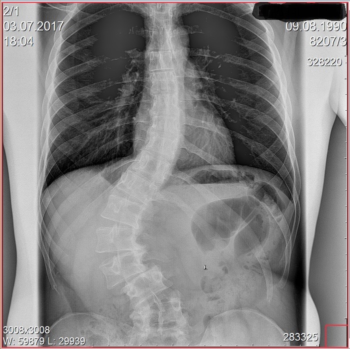 A little about the back - My, Scoliosis, Disease history, Vital, Operation, Pain, Sport, Longpost