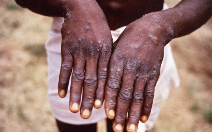 Monkeypox came to Europe. Fever, vomiting and blisters all over the body. - Epidemic, Monkeypox, Great Britain, news