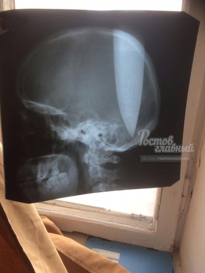 “I wanted my head to breathe”: a resident of the Rostov region stuck a huge dagger in his skull - Rostov-on-Don, Rostov region, Knife, Incident, Self-harm, Psycho, Horror, Video, Longpost