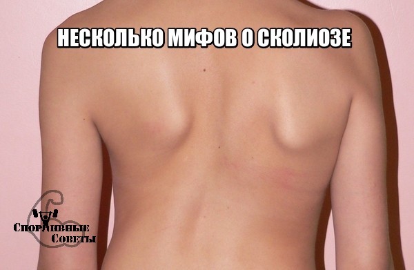 Some myths about scoliosis - Sport, Тренер, Sports Tips, Scoliosis, Posture, Myths, Interesting, Longpost