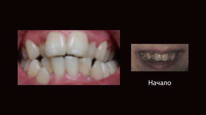 My history with braces, 1 year and 10 months - Longpost, Result, Progress, Teeth, Complexes, Braces, My