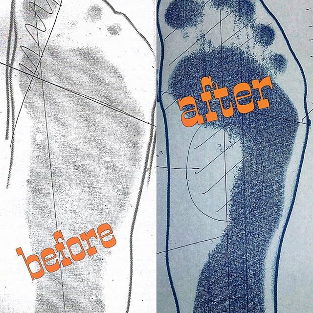 Results - in the studio! - My, Individual insoles, , Orthopedic insoles