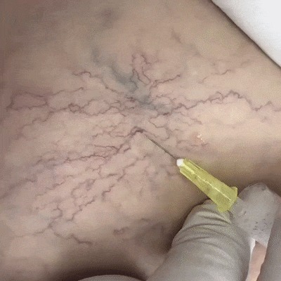 Склеротерапия Гифка, Склеротерапия, Медицина, Жесть, Варикоз