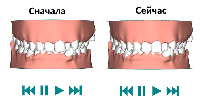 Aligners. Fifth pair. 1-14 days of wear - Longpost, Aligners, Bite correction, Malocclusion, Personal experience, My