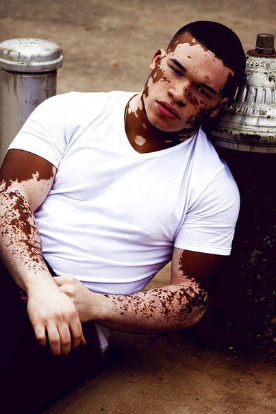 Vitiligo - Skin disease, , Longpost, Dermatology