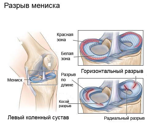 Knee - My, Injury, Meniscus, Meniscus tear, Text
