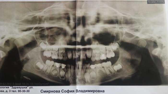 Мешает расти передним зубам