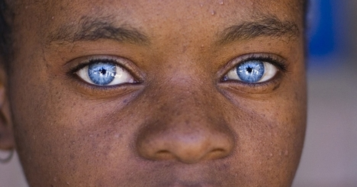 He got green eyes. Синдром Ваарденбурга глаза. Гетерохромия и синдром Ваарденбурга. Синдром Ваарденбурга — мутация. Синдром Ваарденбурга красивые.