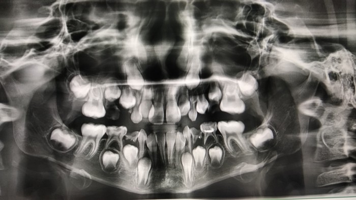 X-ray of a child's teeth - Dentistry, Children, X-ray, X-rays