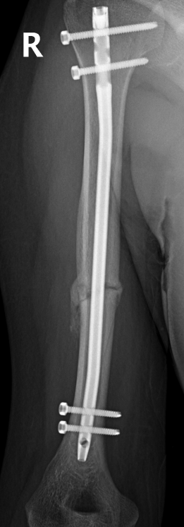 Перелом основание 5 плюсневой кости снимки thumbnail