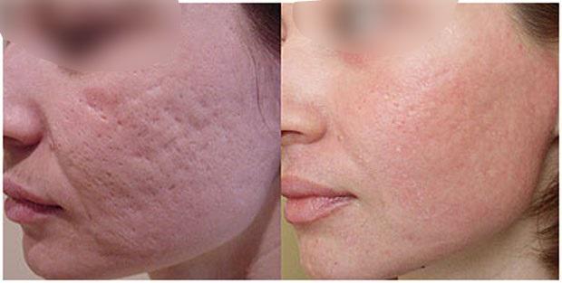 Как улучшить кожу на лице от постакне thumbnail