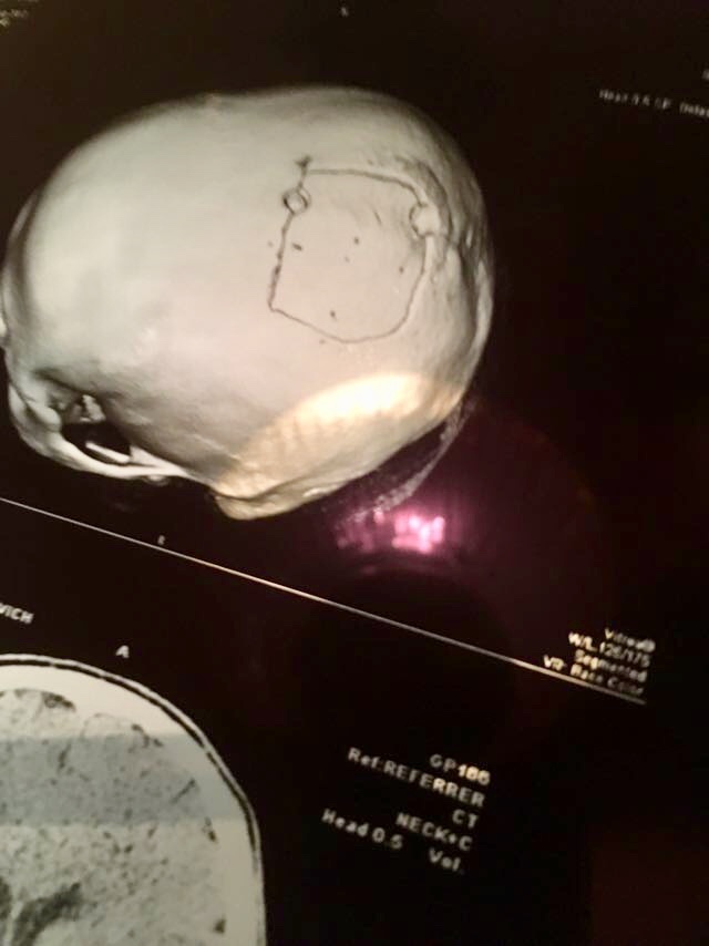 Like I forgot to smoke. - My, Trepanation of the skull, Stroke, Sklifosovsky Research Institute, Resuscitation, Longpost