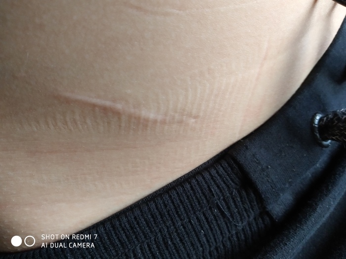 Unsuccessful suture removal - My, Hospital, Operation, Doctor, Seams