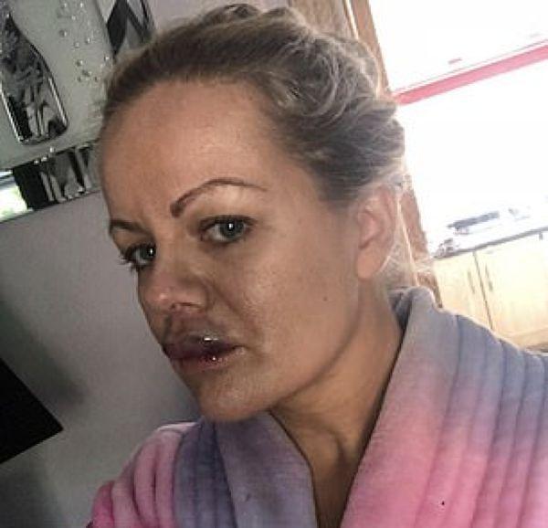 Almost went blind and was left with scars: the mother of 4 children gave herself a lip augmentation - Health, Harm, Carefully, Longpost, Present