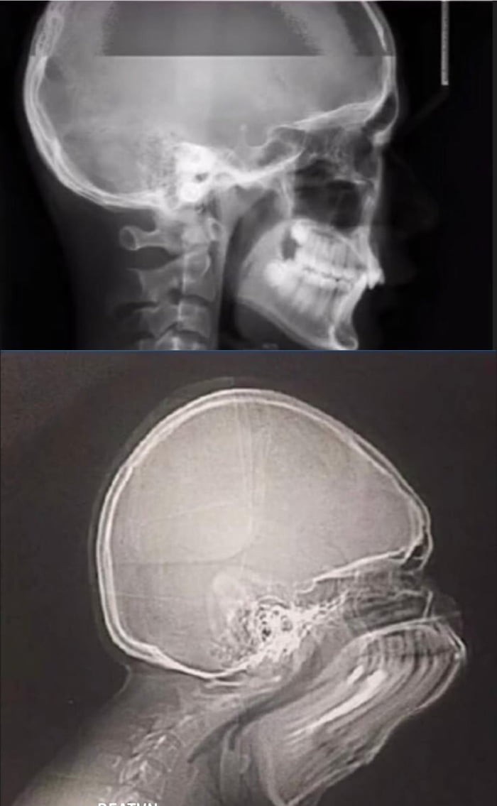 Вот что произойдет, если Вы чихнете во время рентгена Рентген, Фотография, Чих, Чиханье