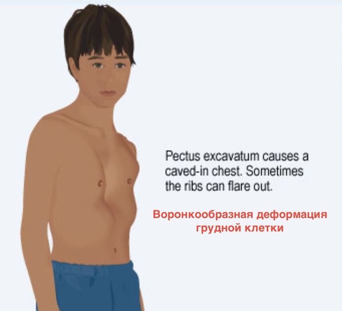 Воронкообразная деформация грудной клетки - Лечение, Медицина, Длиннопост