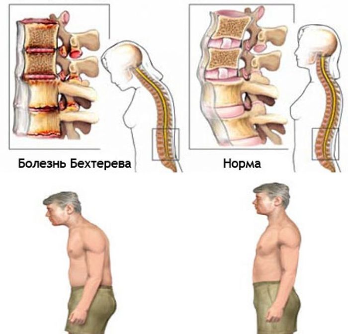 Помощь нуждающимся - Моё, Болезнь Бехтерева, Бесплатно, Медицина