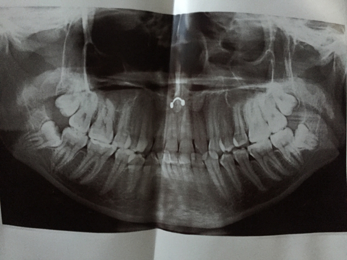 Speaking of piercings and x-rays - My, X-ray, Jaw, 