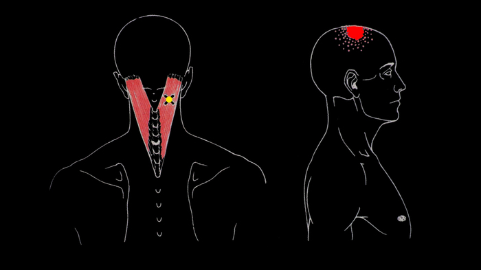 Шейный отдел позвоночника головная боль стягивает шейные мышцы thumbnail