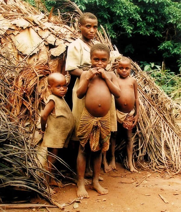 Why African children have big bellies - Health, Children, Africa, Hunger, Longpost