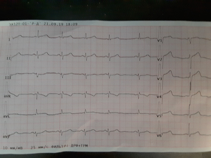 Help decipher ecg. - My, ECG, Heart attack, Longpost