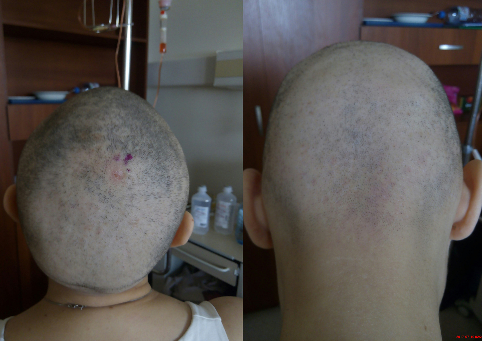 TREATMENT OF HODGKIN'S LYMPHOMA. ESSAY ABOUT HOW I SPENT THE SUMMER. - My, Oncology, Hodgkin's lymphoma, , Chemotherapy, bald, Allopecia, Experiences, Thank you, Longpost