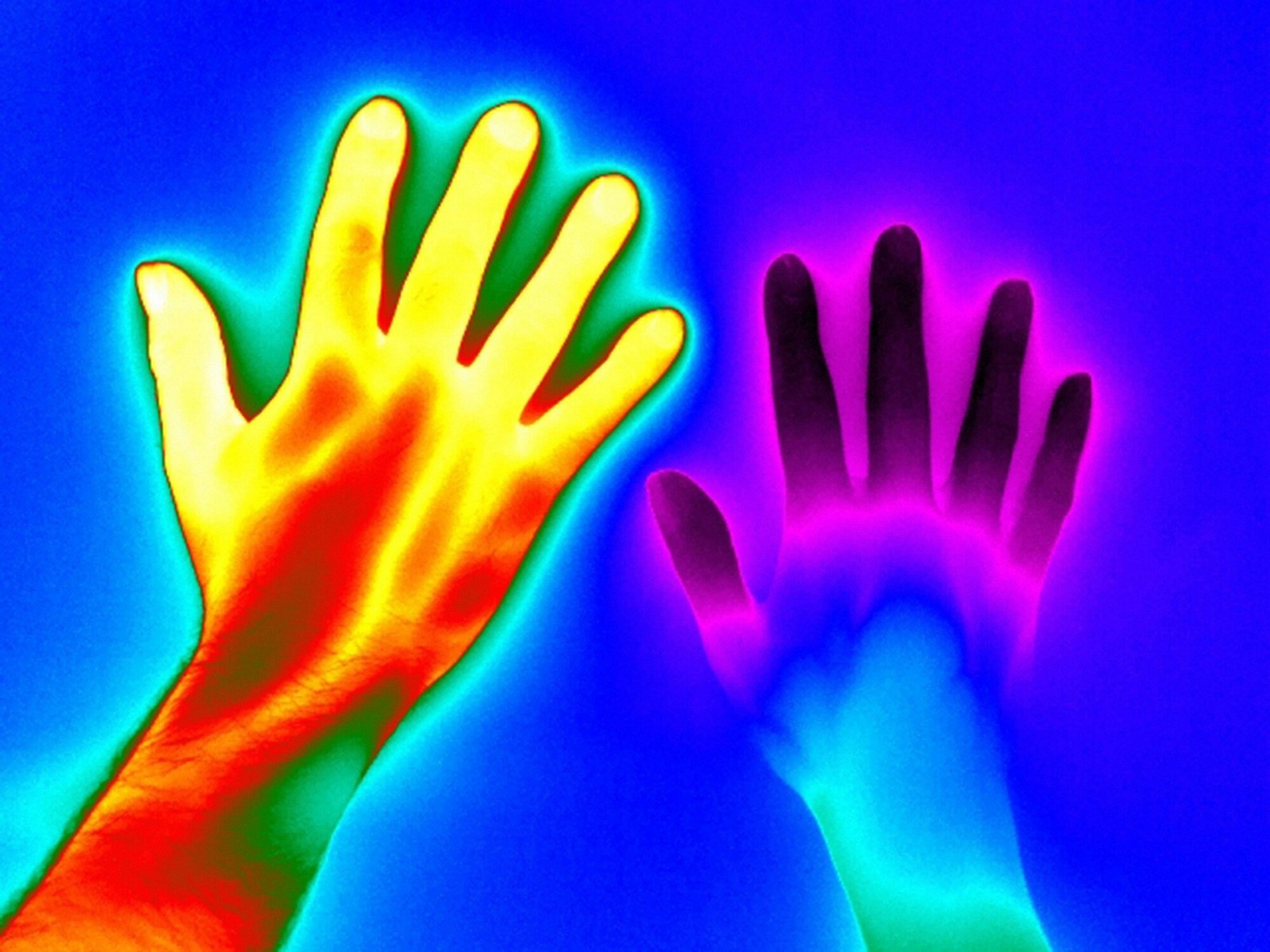 Raynaud's disease. Author: Matthew Clavey - Disease, Arms, Feet