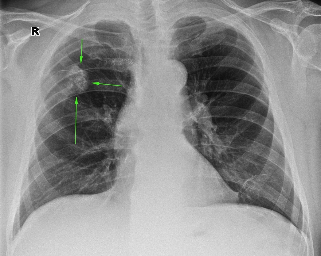 Очаг в верхней доле легкого. Туберкулома легкого рентген. Обызвествление 1 ребра рентген. Очаговый туберкулез легких рентген. Пневмония s6 правого легкого.