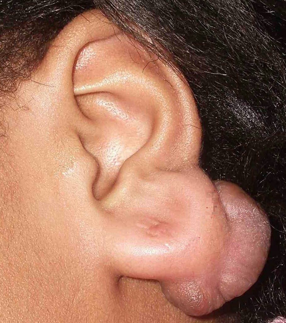 Акупунктурные точки на ушах