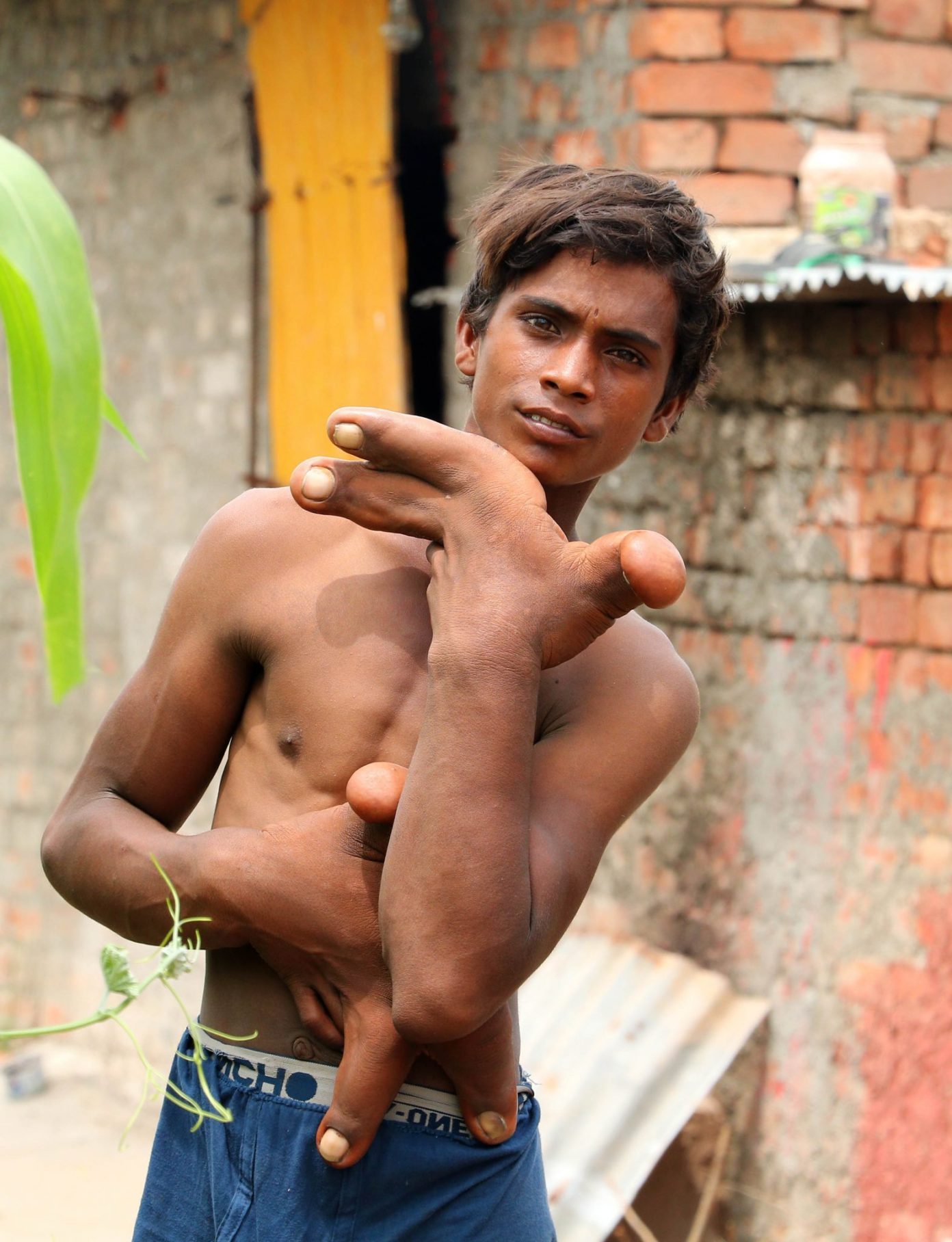 12-летний мальчик с гигантскими руками | Пикабу