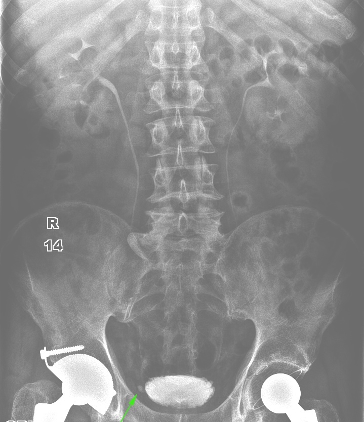 From the life of a radiologist. Part 16 - My, X-ray, The medicine, Fracture, Diverticulitis, Pneumothorax, Hydrothorax, Scoliosis, Longpost