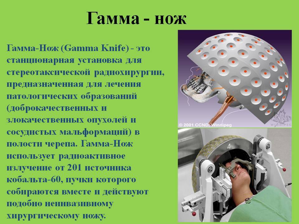 Применение радиоактивности в медицине. Стереотаксическая радиохирургия гамма-нож. Лучевая терапия гамма нож. Аппарат гамма нож.