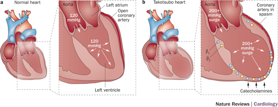 Takotsubo or how to break a heart not figuratively - My, The medicine, Cardiology, Heart, , , Cardiomyopathy