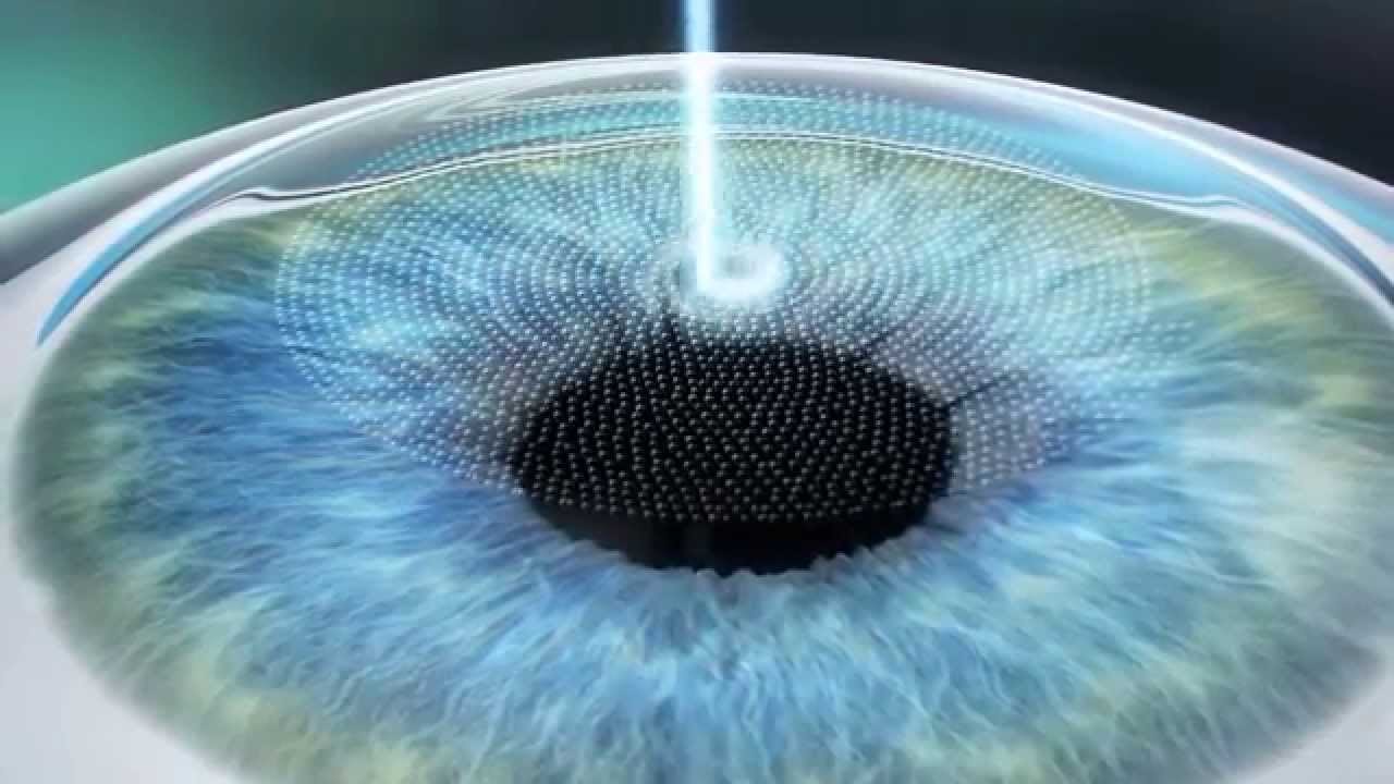 Laser vision correction. The view of the patient. Part 2 - My, Poor eyesight, Vision, Laser correction, The medicine