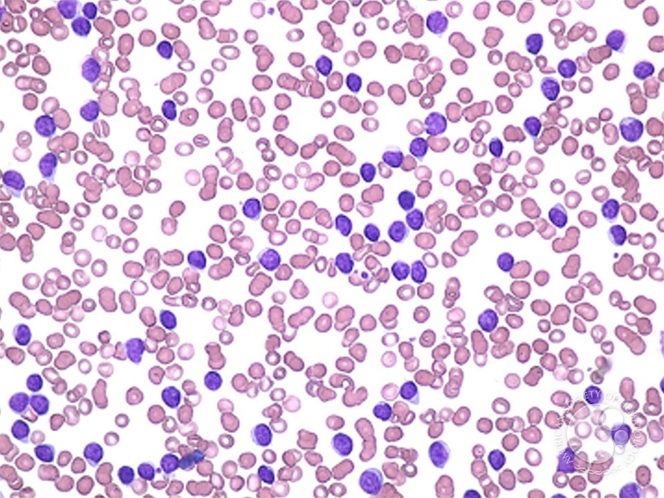 Cycle of Oncohematology. Part 1. Chronic lymphocytic leukemia. - Leukemia, Oncology, The science, Biology, DNA, Longpost