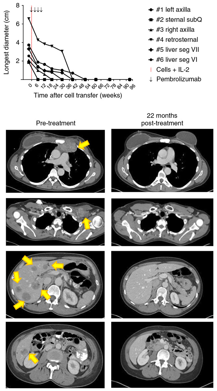 Specially selected lymphocytes from the tumor coped with a severe form of breast cancer - The science, The medicine, Crayfish, Copy-paste, Elementy ru, Longpost