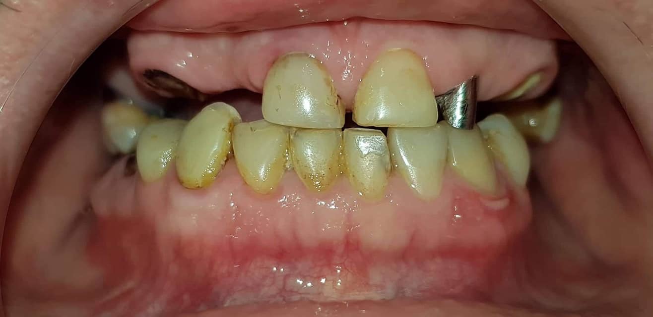 To all my subscribers - what I chose and what happened in the end - My, Dentistry, Implantation, No rating, Teeth, Longpost