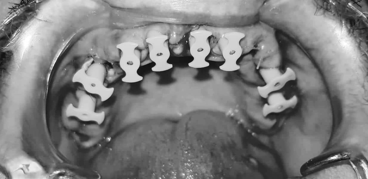 To all my subscribers - what I chose and what happened in the end - My, Dentistry, Implantation, No rating, Teeth, Longpost