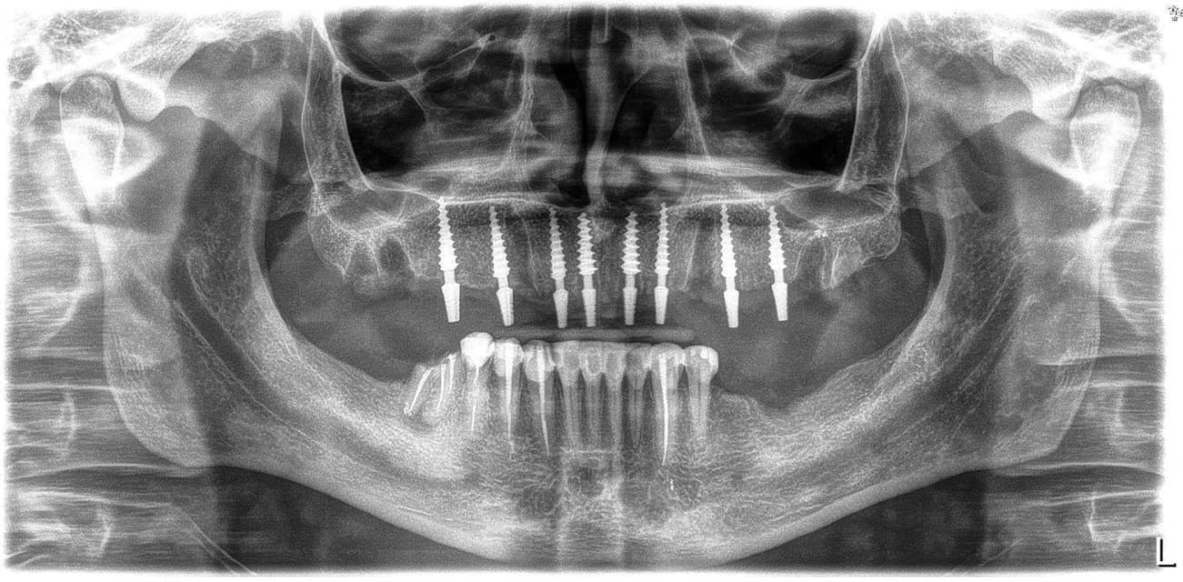 To all my subscribers - what I chose and what happened in the end - My, Dentistry, Implantation, No rating, Teeth, Longpost