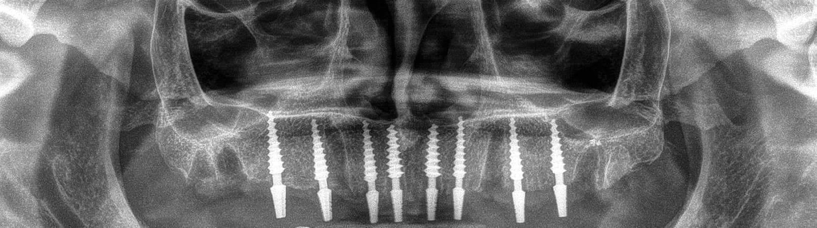 To all my subscribers - what I chose and what happened in the end - My, Dentistry, Implantation, No rating, Teeth, Longpost