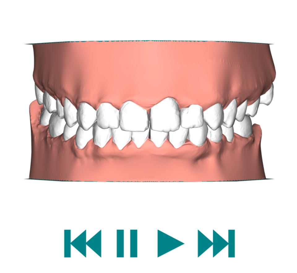 Aligners. Personal experience - My, Aligners, Personal experience, Malocclusion, Bite correction, Longpost